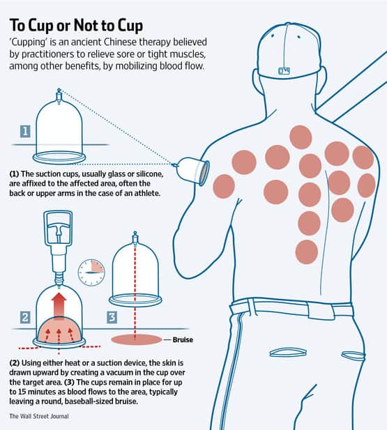 cupping therapy diagram