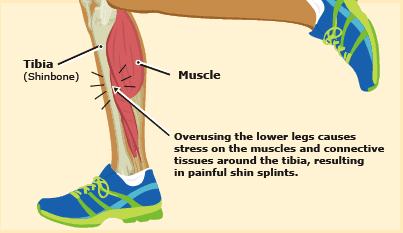 Shin Splints: What causes pain and how 